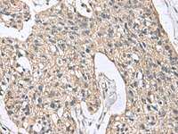 Immunohistochemistry of paraffin-embedded Human esophagus cancer tissue using DPY19L3 Polyclonal Antibody at dilution of 1:110 (×200)