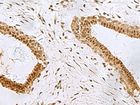 Immunohistochemistry of paraffin-embedded Human breast cancer tissue using PCBD1 Polyclonal Antibody at dilution of 1:90 (×200)