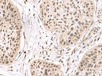 Immunohistochemistry of paraffin-embedded Human esophagus cancer tissue using ERH Polyclonal Antibody at dilution of 1:55 (×200)