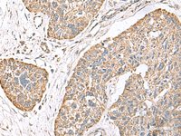 Immunohistochemistry of paraffin-embedded Human esophagus cancer tissue using TMEM141 Polyclonal Antibody at dilution of 1:70 (×200)