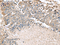 Immunohistochemistry of paraffin-embedded Human liver cancer tissue using TMEM141 Polyclonal Antibody at dilution of 1:70 (×200)