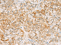 Immunohistochemistry of paraffin-embedded Human liver cancer tissue using SH3YL1 Polyclonal Antibody at dilution of 1:55 (×200)