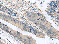 Immunohistochemistry of paraffin-embedded Human colorectal cancer tissue using NPHP1 Polyclonal Antibody at dilution of 1:60 (×200)