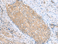 Immunohistochemistry of paraffin-embedded Human cervical cancer tissue using PHPT1 Polyclonal Antibody at dilution of 1:170 (×200)