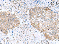 Immunohistochemistry of paraffin-embedded Human cervical cancer tissue using PAM16 Polyclonal Antibody at dilution of 1:50 (×200)