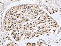 Immunohistochemistry of paraffin-embedded Human esophagus cancer tissue using H2AFJ Polyclonal Antibody at dilution of 1:160 (×200)