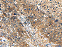 Immunohistochemistry of paraffin-embedded Human liver cancer tissue using TPD52L3 Polyclonal Antibody at dilution of 1:140 (×200)