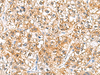 Immunohistochemistry of paraffin-embedded Human liver cancer tissue using RIDA Polyclonal Antibody at dilution of 1:70 (×200)