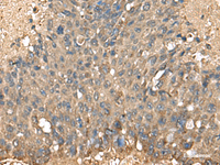 Immunohistochemistry of paraffin-embedded Human liver cancer tissue using MRPL42 Polyclonal Antibody at dilution of 1:60 (×200)