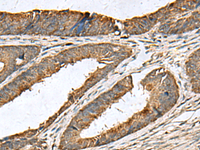 Immunohistochemistry of paraffin-embedded Human colorectal cancer tissue using MRPL42 Polyclonal Antibody at dilution of 1:60 (×200)