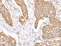 Immunohistochemistry of paraffin-embedded Human esophagus cancer tissue using PLA2G2A Polyclonal Antibody at dilution of 1:55 (×200)