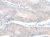 Immunohistochemistry of paraffin-embedded Human colorectal cancer tissue using RPS16 Polyclonal Antibody at dilution of 1:65 (×200)