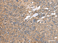 Immunohistochemistry of paraffin-embedded Human liver cancer tissue using AHNAK Polyclonal Antibody at dilution of 1:100 (×200)
