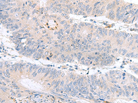 Immunohistochemistry of paraffin-embedded Human colorectal cancer tissue using PDE6D Polyclonal Antibody at dilution of 1:60 (×200)