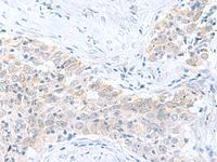 Immunohistochemistry of paraffin-embedded Human esophagus cancer tissue using PDE6D Polyclonal Antibody at dilution of 1:60 (×200)