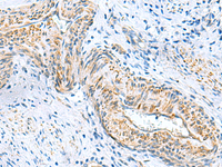 Immunohistochemistry of paraffin-embedded Human cervical cancer tissue using MYL1 Polyclonal Antibody at dilution of 1:75 (×200)