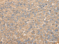 Immunohistochemistry of paraffin-embedded Human liver cancer tissue using RPS14 Polyclonal Antibody at dilution of 1:60 (×200)