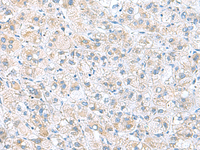 Immunohistochemistry of paraffin-embedded Human liver cancer tissue using DNAL1 Polyclonal Antibody at dilution of 1:50 (×200)