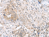 Immunohistochemistry of paraffin-embedded Human cervical cancer tissue using STK32A Polyclonal Antibody at dilution of 1:90 (×200)