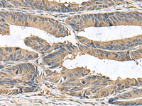 Immunohistochemistry of paraffin-embedded Human colorectal cancer tissue using ZG16 Polyclonal Antibody at dilution of 1:95 (×200)