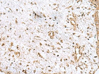 Immunohistochemistry of paraffin-embedded Human breast cancer tissue using AK6 Polyclonal Antibody at dilution of 1:90 (×200)