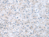 Immunohistochemistry of paraffin-embedded Human liver cancer tissue using TXNDC12 Polyclonal Antibody at dilution of 1:60 (×200)