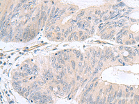 Immunohistochemistry of paraffin-embedded Human colorectal cancer tissue using NMU Polyclonal Antibody at dilution of 1:60 (×200)