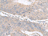 Immunohistochemistry of paraffin-embedded Human colorectal cancer tissue using RNF208 Polyclonal Antibody at dilution of 1:55 (×200)