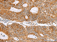 Immunohistochemistry of paraffin-embedded Human colorectal cancer tissue using MRPS28 Polyclonal Antibody at dilution of 1:105 (×200)