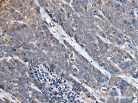 Immunohistochemistry of paraffin-embedded Human thyroid cancer tissue using MCM10 Polyclonal Antibody at dilution of 1:50 (×200)