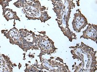 Immunohistochemistry of paraffin-embedded Human ovarian cancer tissue using MCM10 Polyclonal Antibody at dilution of 1:50 (×200)