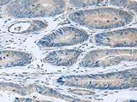 Immunohistochemistry of paraffin-embedded Human colorectal cancer tissue using HPCAL1 Polyclonal Antibody at dilution of 1:90 (×200)