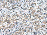 Immunohistochemistry of paraffin-embedded Human liver cancer tissue using COMMD9 Polyclonal Antibody at dilution of 1:55 (×200)