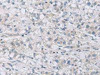 Immunohistochemistry of paraffin-embedded Human liver cancer tissue using ITGB1BP1 Polyclonal Antibody at dilution of 1:60 (×200)