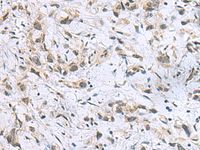 Immunohistochemistry of paraffin-embedded Human gastric cancer tissue using ITGB1BP1 Polyclonal Antibody at dilution of 1:60 (×200)