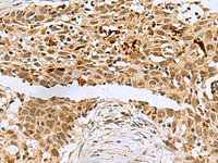 Immunohistochemistry of paraffin-embedded Human esophagus cancer tissue using BCL7B Polyclonal Antibody at dilution of 1:60 (×200)
