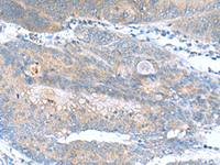 Immunohistochemistry of paraffin-embedded Human colorectal cancer tissue using JOSD1 Polyclonal Antibody at dilution of 1:90 (×200)