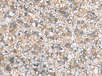 Immunohistochemistry of paraffin-embedded Human liver cancer tissue using MRPL22 Polyclonal Antibody at dilution of 1:60 (×200)