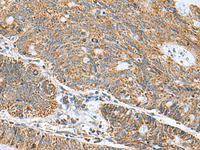 Immunohistochemistry of paraffin-embedded Human colorectal cancer tissue using MRPL40 Polyclonal Antibody at dilution of 1:50 (×200)