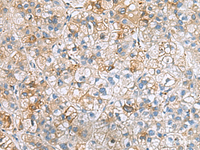 Immunohistochemistry of paraffin-embedded Human liver cancer tissue using IGLL1 Polyclonal Antibody at dilution of 1:50 (×200)