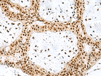 Immunohistochemistry of paraffin-embedded Human breast cancer tissue using PRPF40A Polyclonal Antibody at dilution of 1:60 (×200)