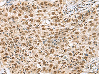 Immunohistochemistry of paraffin-embedded Human esophagus cancer tissue using PRPF40A Polyclonal Antibody at dilution of 1:60 (×200)