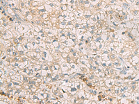 Immunohistochemistry of paraffin-embedded Human liver cancer tissue using SLC30A6 Polyclonal Antibody at dilution of 1:70 (×200)