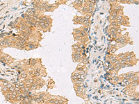 Immunohistochemistry of paraffin-embedded Human prost ate cancer tissue using SLC30A6 Polyclonal Antibody at dilution of 1:70 (×200)