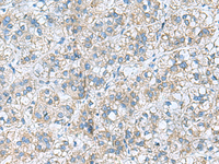 Immunohistochemistry of paraffin-embedded Human liver cancer tissue using RPL10A Polyclonal Antibody at dilution of 1:50 (×200)
