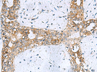 Immunohistochemistry of paraffin-embedded Human breast cancer tissue using RPL10A Polyclonal Antibody at dilution of 1:50 (×200)