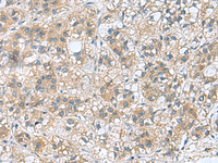 Immunohistochemistry of paraffin-embedded Human liver cancer tissue using RAB39A Polyclonal Antibody at dilution of 1:70 (×200)