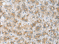 Immunohistochemistry of paraffin-embedded Human liver cancer tissue using TMED10 Polyclonal Antibody at dilution of 1:50 (×200)