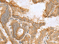 Immunohistochemistry of paraffin-embedded Human thyroid cancer tissue using CCDC134 Polyclonal Antibody at dilution of 1:50 (×200)