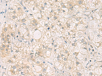 Immunohistochemistry of paraffin-embedded Human liver cancer tissue using LRAT Polyclonal Antibody at dilution of 1:50 (×200)